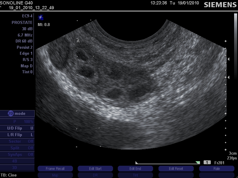 prostatitis ultrasound images